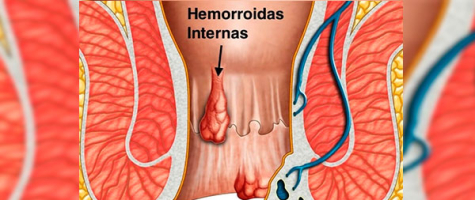 Tratamentos minimamente invasivos para hemorroidas Tratamentos minimamente invasivos para hemorroidas