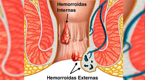 Tratamentos minimamente invasivos para hemorroidas Tratamentos minimamente invasivos para hemorroidas
